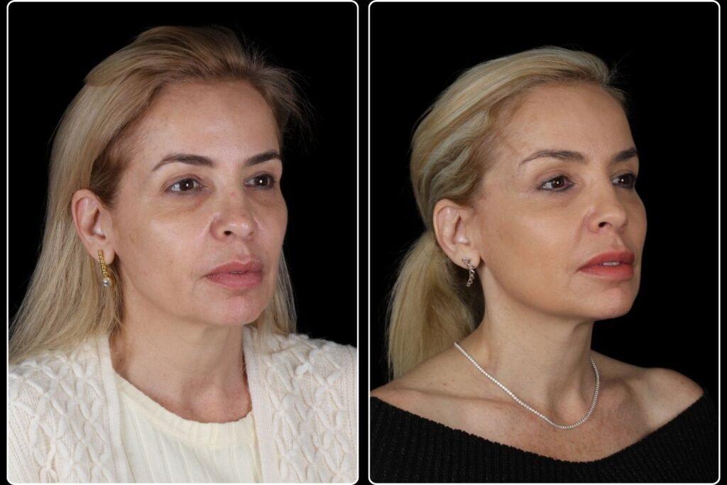 Antes e depois - Lifting de Temporal - Nulab Cursos