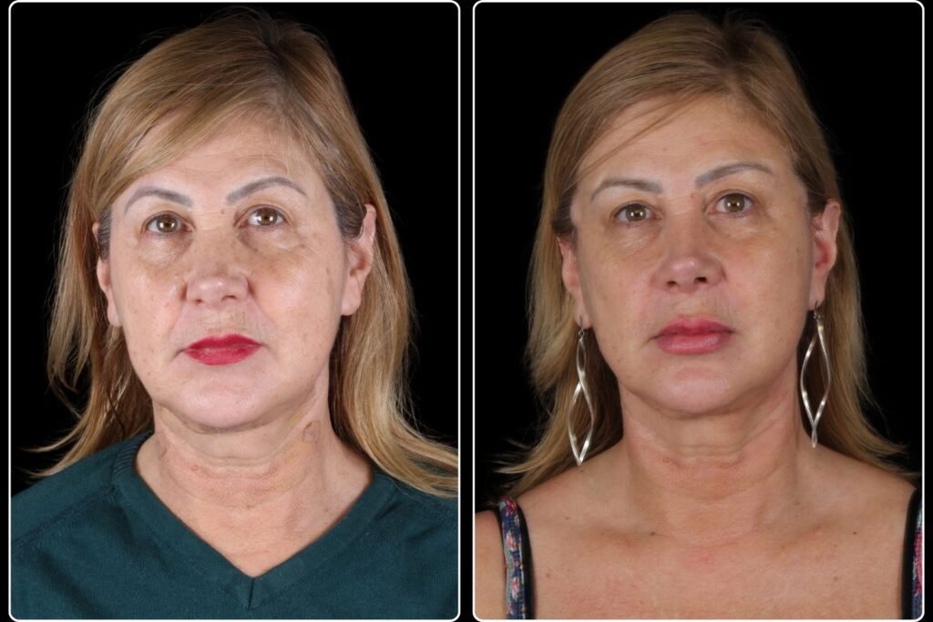 Antes e depois - Lifting de Temporal - Nulab Cursos